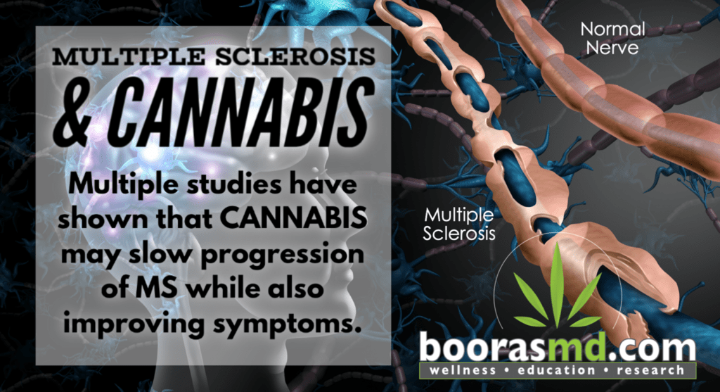 Multiple Sclerosis (MS) and Medical Marijuana (Cannabis) | BoorasMD Cannabis  Wellness